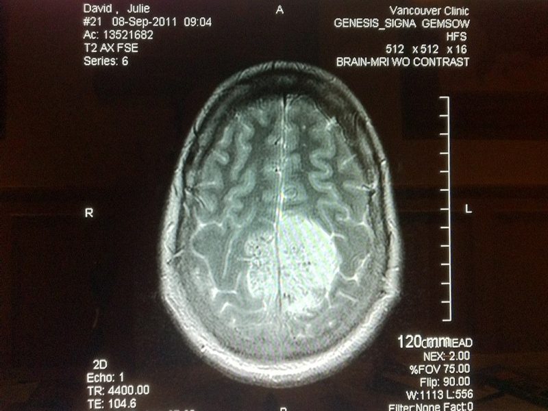 Brain X-Ray of Julie Alejado David